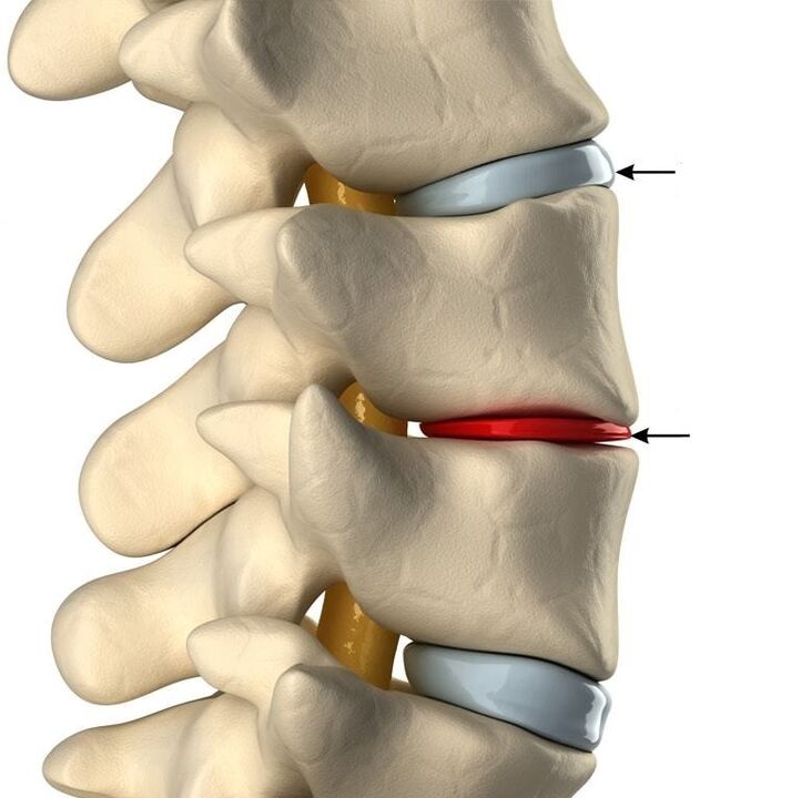 Отличие здорового диска от диска с остеохондрозом